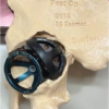 Custom-Made Monoflange Acetabular Component for Revision Hip Arthroplasty in Paprosky Type IIIA Defect: A Case Report