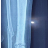 Successful Salvage of Infected Tibial Shaft Non-union After Implant Removal with Ilizarov External Fixation: A Case Report