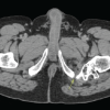 Lesser Trochanter Osteochondroma as an Etiology for Ischiofemoral Impingement: A case report