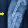 Early Mobilization with Mechanical Axis Preservation: A Prospective Outcome Analysis of Titanium Elastic Nailing in Femoral Shaft Fractures of School-Aged Children
