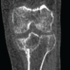 Restoration of Limb Alignment in Post-Traumatic Genu Varum Case Using Medial Open Wedge Proximal Tibial Osteotomy with Posterior Tibial Slope Correction: A Case Report