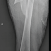 Two-Stage Reconstruction for Failed Subtrochanteric Femur Fixation with Peri-Implant Infection and Severe Proximal Femoral Bone Loss: A Case Report