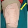 ‘No Dressing’ Strategy for Post-operative Orthopedic Cases