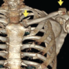 Bipolar Clavicle Fracture: A Rare Entity of the Commonest Fracture – A Case Report