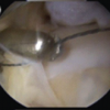 Functional Outcomes of All-Inside Arthroscopic Repair for Chronic Ankle Instability in Adolescents: A Case Series