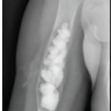 Novel Application of the AGN1 Triphasic Calcium-Based Implant for a Large Simple Bone Cyst in a Child With 3-Year Follow-up: A Case Report