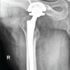 A Novel Failure Interface in Constrained Total Hip Arthroplasty: Dissociation at the Constrained Liner Insert-Bipolar Head Junction Following Periprosthetic Joint Infection
