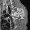 Adolescent Paraspinal Lipoblastoma: A Case Report