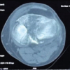Three-column Plating for Complex Tibial Plateau Fractures: Multivariate Predictors of Superior Functional Recovery