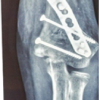 Oblique Close Wedge versus Modified Step Cut Osteotomy for Cubitus Varus Deformity in Children: A Prospective Non-Randomized Study