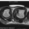 Radiographic Findings and Novel Intraoperative Approach to Saddle Syndrome: A Case Presentation