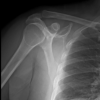 Arthroscopic Fixation of Acute Reverse Bony Bankart Lesion using Cancellous Cannulated Screws: A Rare Case Report