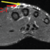 Excision without Reconstruction of a Traumatically Ruptured Extensor Indicis Proprius Tendon in a Diabetic Patient: A Case Report