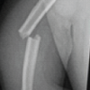 Anterior Bridge Plate Through Minimally Invasive Approach: A Game-changer for Humeral Shaft Fracture: A Clinical Case Series