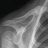 Serendipitous Healing of a Congenital Pseudoarthrosis of the Clavicle Following Acute Injury: A Case Report