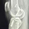Standardized Preparation and Multi-Site Application of Leukocyte-Poor Platelet-Rich Plasma in Arthroscopic Anterior Cruciate Ligament Reconstruction: A Technical Note with Early Functional Outcomes