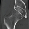 Achieving Safe Zone Cup Positioning in Total Hip Arthroplasty using Anatomical Landmarks: A Prospective Computed Tomography-based Evaluation