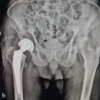 Cemented versus Uncemented Hemiarthroplasty in Femoral Neck Fractures: A Comparative Case Series Using Singh Index for Surgical Decision-Making