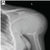 Short-term Functional Outcomes of Shoulder Girdle Limb Salvage in Primary Bone Tumors: A 2-year Follow-up Study