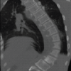 Surgical Management of Progressive Scoliosis in Crisponi Syndrome: Multidisciplinary Perioperative Strategy and Technical Considerations