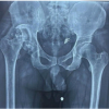 Total Hip Arthroplasty without Subtrochanteric Shortening Osteotomy in a Neglected Posterior Hip Dislocation: A Case Report