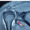 Humeral Avulsion of Glenohumeral Ligament Lesion – A Case Report and Surgical Considerations