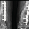 Comparison of Surgical Outcomes and Perioperative Laboratory Parameters Following Minimally Invasive Plate Osteosynthesis versus Conventional Plating in Long Bone Fractures