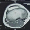 Cortical Lytic Lesion of the Proximal Tibia in an 8-Year-Old Child: A Pediatric Diagnostic Conundrum