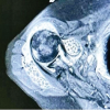 Secondary Synovial Chondromatosis of the Shoulder Associated with Rotator Cuff Tear: Diagnostic Challenge and Arthroscopic Management – A Case Report