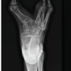 Reconstructive Surgery for Foot Ectrodactyly in an Adolescent Patient: A Case Report