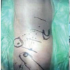 Direct Anterior THA with Leg Positioning Traction System for Avascular Necrosis: Technique and Early Outcomes