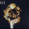 Aneurysmal Bone Cyst of the Proximal Humerus Managed with En Bloc Resection, Fibular Strut Grafting, and PHILOS Fixation: A Case Report