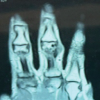 Post-Traumatic Turret Exostosis of the Proximal Phalanx of the Middle Finger: A Rare Case Report and Review of Literature
