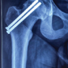 A 5-Year Outcome of Closed Reduction and Screw Fixation for an Atypical Slipped Capital Femoral Epiphysis Associated with Hypogonadism: A Case Report