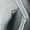 A Rare Neglected Ipsilateral Humeral Triad: Comminuted Proximal Humerus Nonunion with Avascular Necrosis, Mid-Shaft Fracture, and High Radial Nerve Palsy Managed with Staged Reconstruction