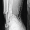Staged Reconstruction Strategy for Gustilo Type IIIB and IIIC Open Fractures: A Case Series of 23 Patients