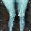 Sequential Development and Staged Management of Distal Femoral Osteochondroma with Progressive Bilateral Genu Valgum: A Case Report