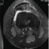 Arthroscopic-assisted Suture-based Fixation of Patellar Osteochondral Fractures using the DG-lock Suturing: A Novel Technique