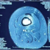 Diagnostic Dilemma in a Distal Femoral Intramedullary Lesion: Enchondroma Mimicking Low-Grade Chondrosarcoma with Discordant Biopsy Findings: A Case Report