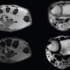 Lipofibromatous Hamartoma of the Median and Ulnar Nerves: A Case Report
