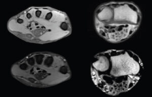 Figure 1: Magnetic resonance imaging images of a transverse cut through the base of the fingers to the wrist showing the median and ulnar nerve with its lipomatous infiltration.