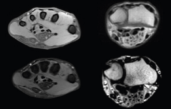 Figure 1: Magnetic resonance imaging images of a transverse cut through the base of the fingers to the wrist showing the median and ulnar nerve with its lipomatous infiltration.