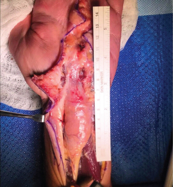 Figure 2: Clinical photograph, characteristic fusiform enlargement of the median nerve at the distal third of the forearm and distally, extending into the carpal tunnel.