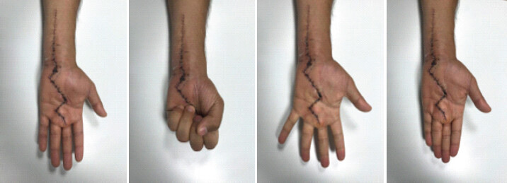 Figure 3: Clinical photograph, 8 weeks after surgery, showing total recovery of medial and cubital nerve function.
