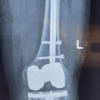 Early Mechanical Dissociation of Helical Blade-Barrel Interface in Proximal Femoral Nail: A Case Report
