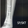 A Rare Case of Giant Cell tumor of Bone in Distal Tibia