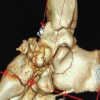 Traumatic Case of Comminuted, Shattered Navicular Bone Fracture: A Rare Case of Midfoot Catastrophe