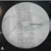 Acute Cauda Equina Syndrome Following Transpedicular Biopsy of a Lumbar Vertebral Lesion: A Case Report of Spinal Non-Hodgkin’s Lymphoma