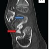 Concurrent Occurrence of Dysplasia Epiphysealis Hemimelica involving Lateral Malleolus and Sinus Tarsi: Rare Case with Review of Literature