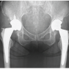 A Case of Bilateral Steroid Arthropathy of the Hip Following Repeated Intra-articular Steroid Injections